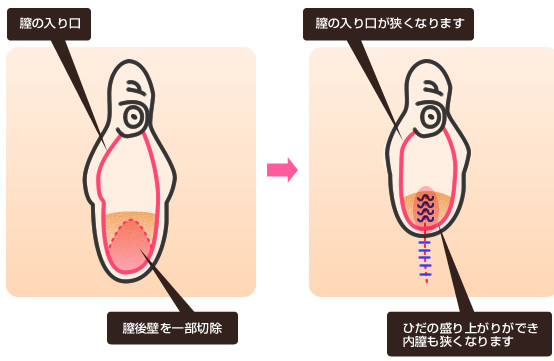 膣の縮小手術